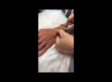 Hand Restoration Using A Microcannula And Restylane Lyft
