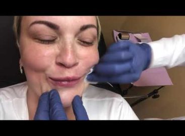 Lip Augmentation with Juvederm Ultra