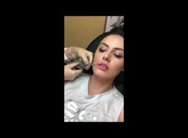 Lip Augmentation with Juvederm Ultra Plus Dermal Filler