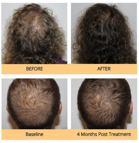 Before & After Hydrafacial Treatment Avon CT keravive before & after treatment avon ct