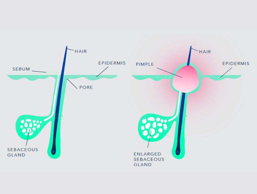 acneform acneform