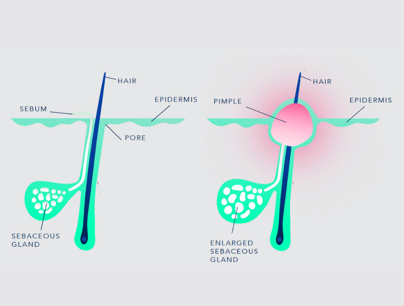 acneform