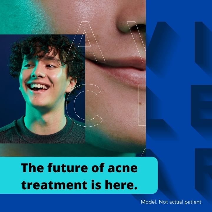 AviClear Acne Treatment Avon CT aviclear acne treatment avon ct