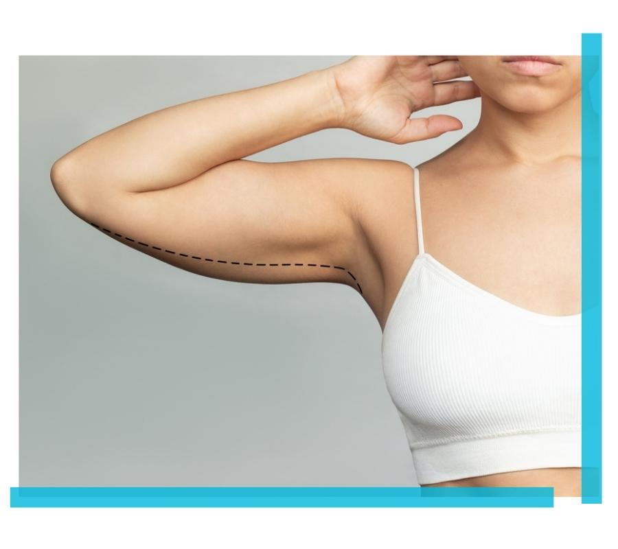 coolsculpting for arms avon ct