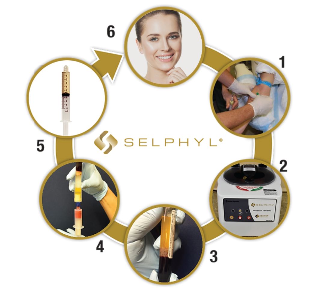 selphyl-treatment-process1 selphyl-treatment-process1