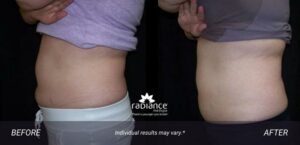 coolsculpting-elite-avon-abdominal1