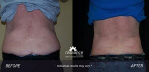 coolsculpting-elite-avon-flanks1