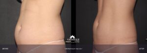 coolsculpting-hartfordct-abdomen2