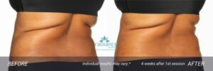 coolsculptingelite-abdomen-in-avon1