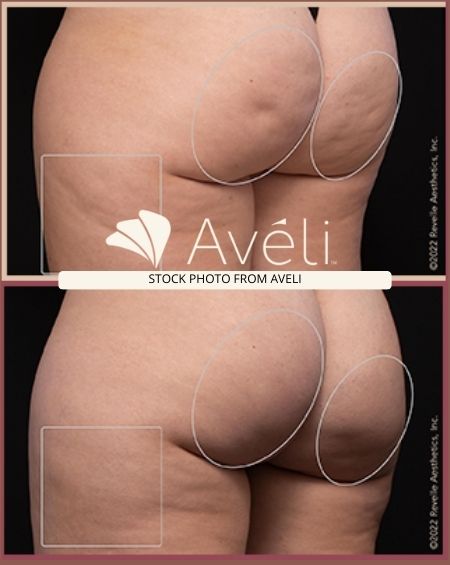 I Tried the Avéli Cellulite Treatment on My Butt and Thighs — With Before and Afters